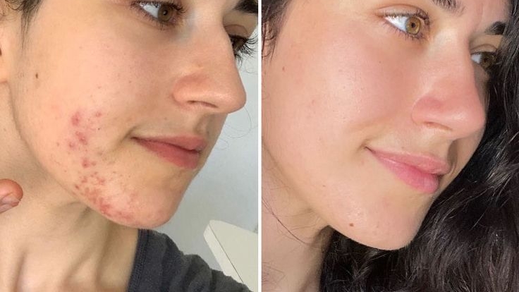 Parlak, pürüzsüz, doğal! Cilt lekelerine bitkisel çözüm evinizde gizli 10 4 21 edited
