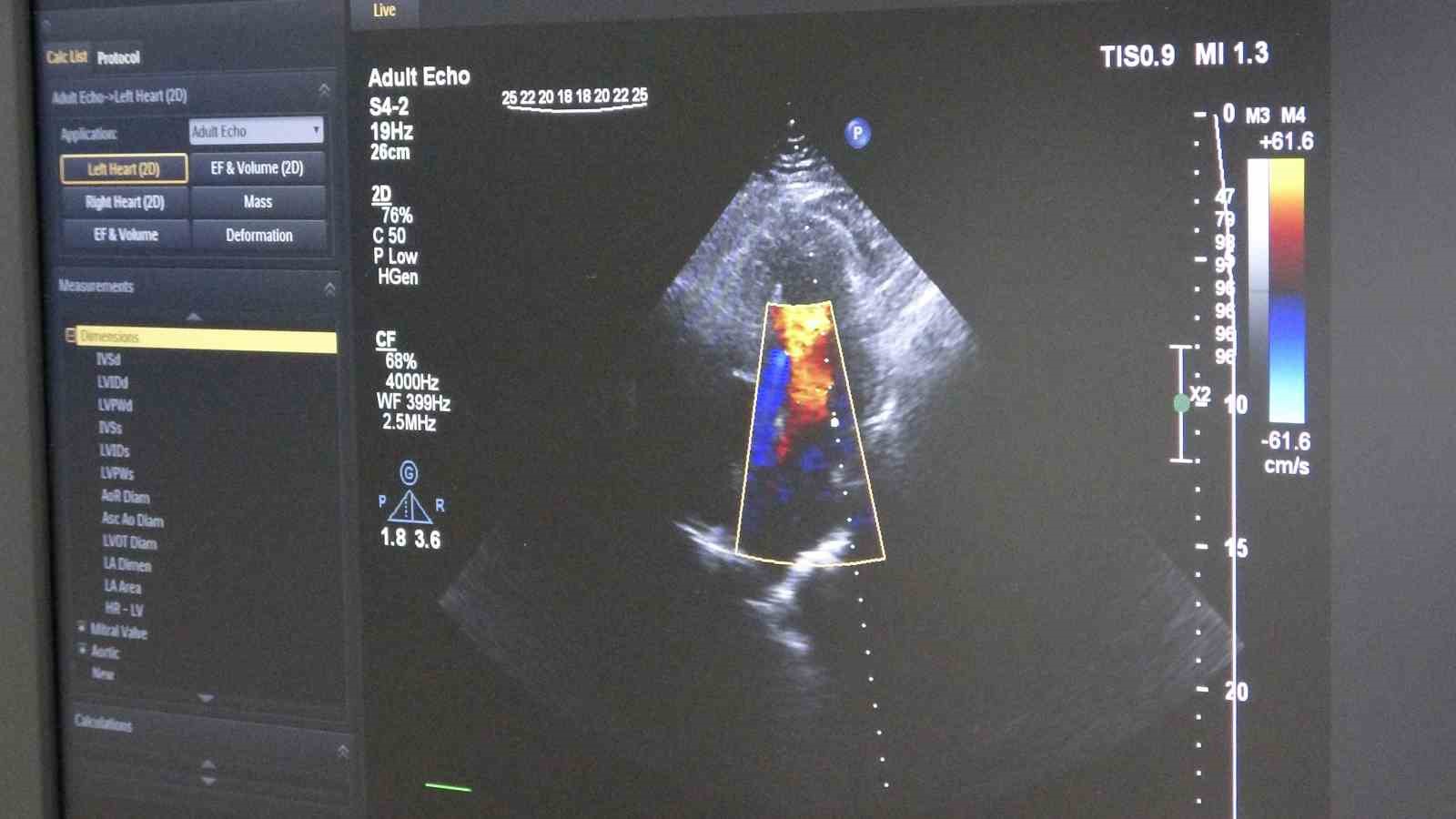 Ameliyatsız, stentsiz tedavi: Kalp damarları ilaç kaplı balonla açıldı 8 ameliyatsiz stentsiz tedavi kalp damarlari ilac kapli balonla acildi 4 lzqNwAiL