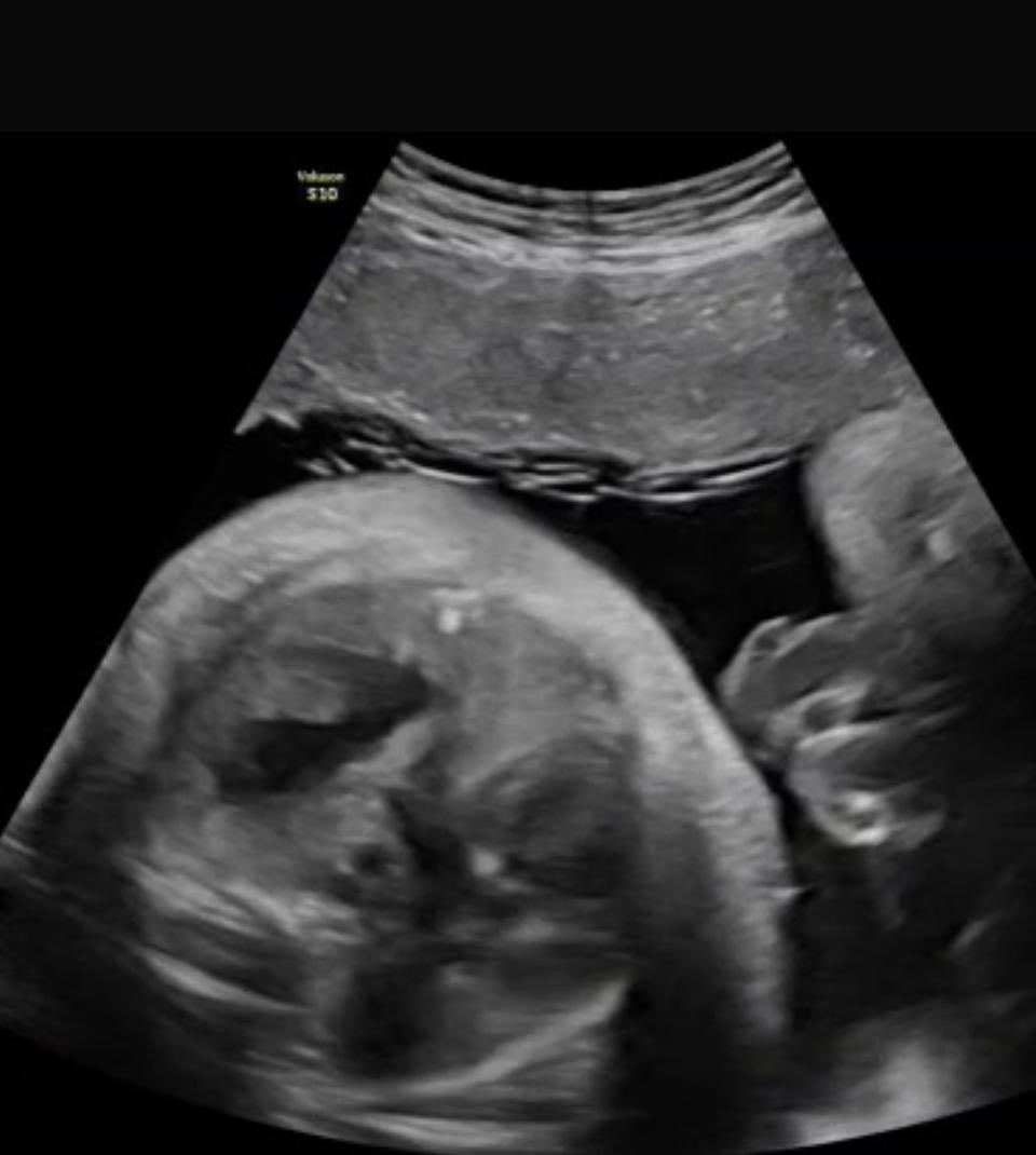 anne karnindaki bebegin cigerine operasyon 4