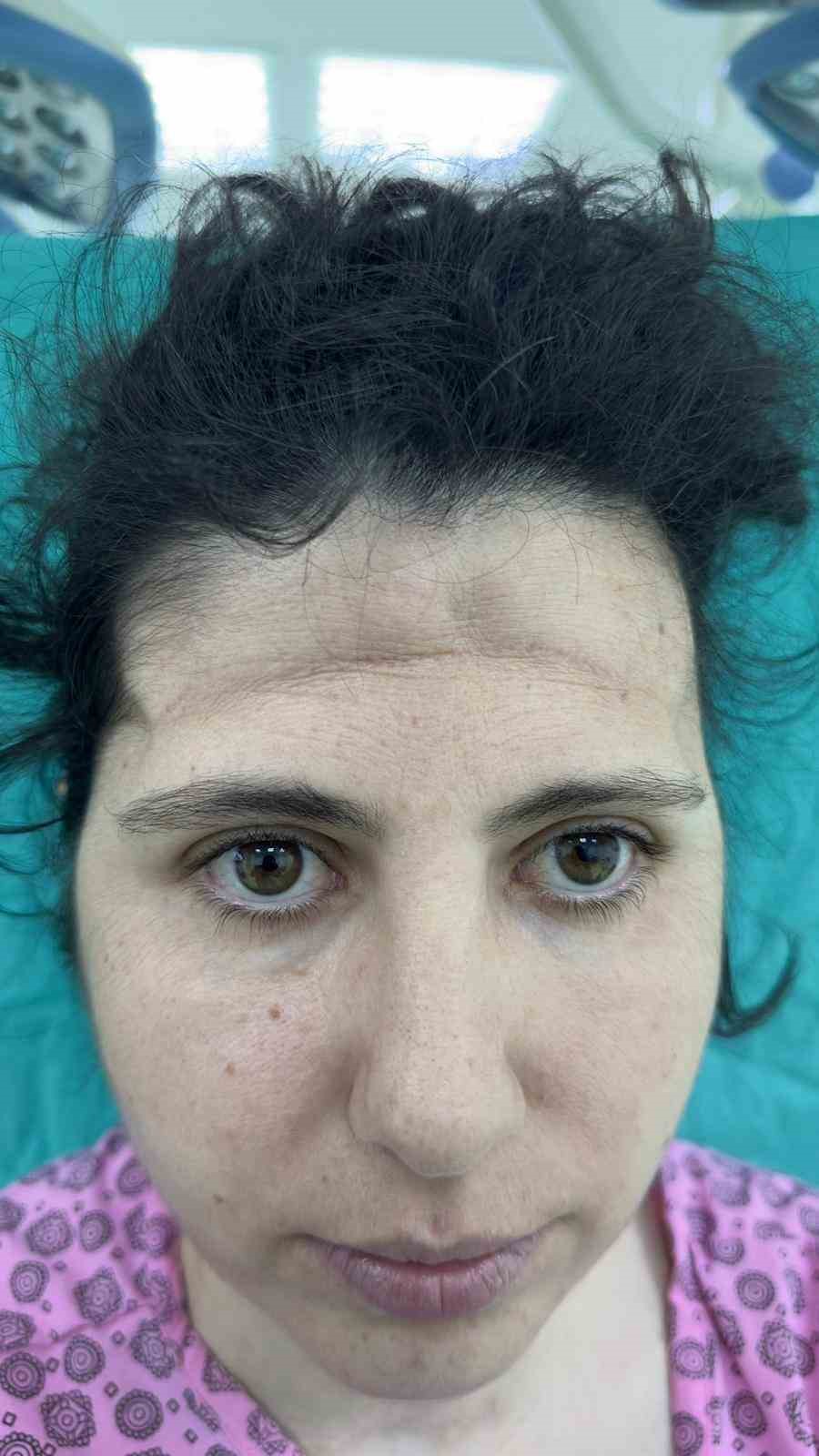 Beyin tümörü ameliyatı sonrası çöken alnı, 3 boyutlu implantla düzeltildi 9 beyin tumoru ameliyati sonrasi coken alni 3 boyutlu implantla duzeltildi 5 FAdnlXLn