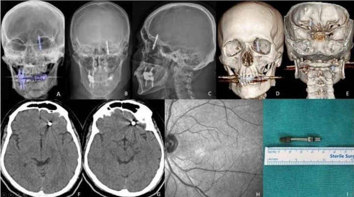 beynine saplanan implant hayatini karartti 2 yildir adalet bekliyor 0 6drm14Ch