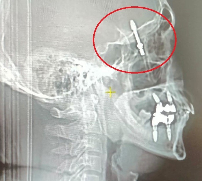 beynine saplanan implant hayatini karartti 2 yildir adalet bekliyor 1 EFa4HpAC