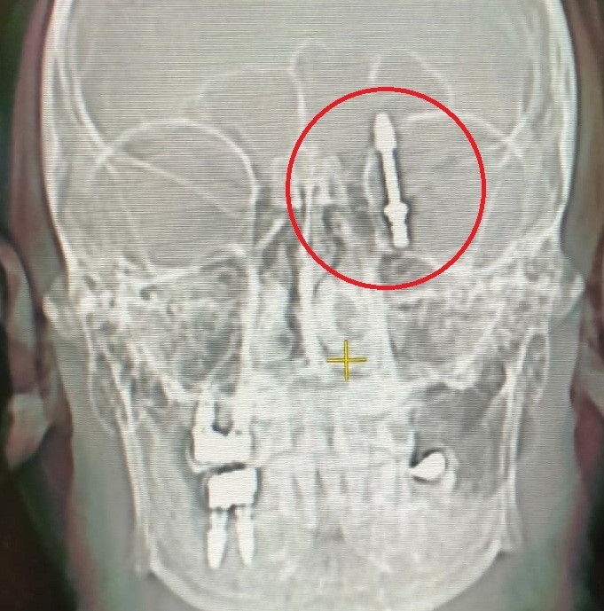 beynine saplanan implant hayatini karartti 2 yildir adalet bekliyor 4 w4XVIv5D