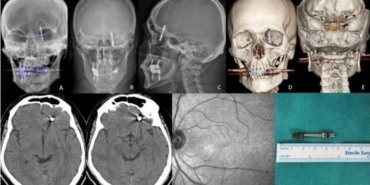 beynine-saplanan-implant-hayatini-karartti-2-yildir-adalet-bekliyor-qBNkSN2Z.jpg