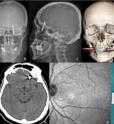 beynine-saplanan-implant-hayatini-karartti-2-yildir-adalet-bekliyor-qBNkSN2Z.jpg