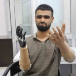 demirin-elektrik-tellerine-degmesiyle-hayati-kararan-muhammed-3-milyon-tl-degerindeki-protez-bacagina-ve-2bNHs248.jpg