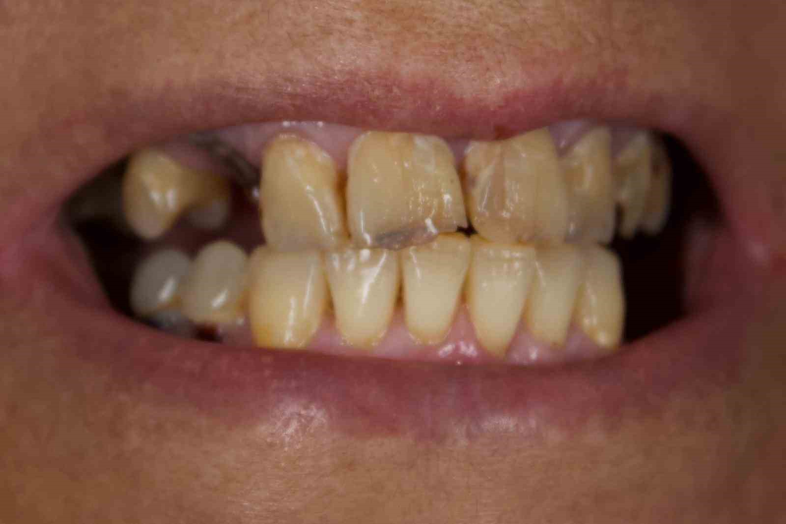 Depremlerden etkilendi, diş tedavisinde implantı rafa kaldıracak cam fiber uygulamasını geliştirdi 9 depremlerden etkilendi dis tedavisinde implanti rafa kaldiracak cam fiber uygulamasini gelistirdi 5 mk5prf2M