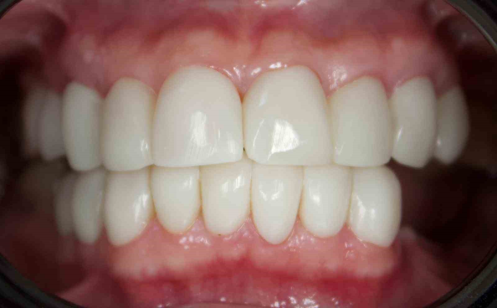 Depremlerden etkilendi, diş tedavisinde implantı rafa kaldıracak cam fiber uygulamasını geliştirdi 12 depremlerden etkilendi dis tedavisinde implanti rafa kaldiracak cam fiber uygulamasini gelistirdi 8 UgQBrO9e