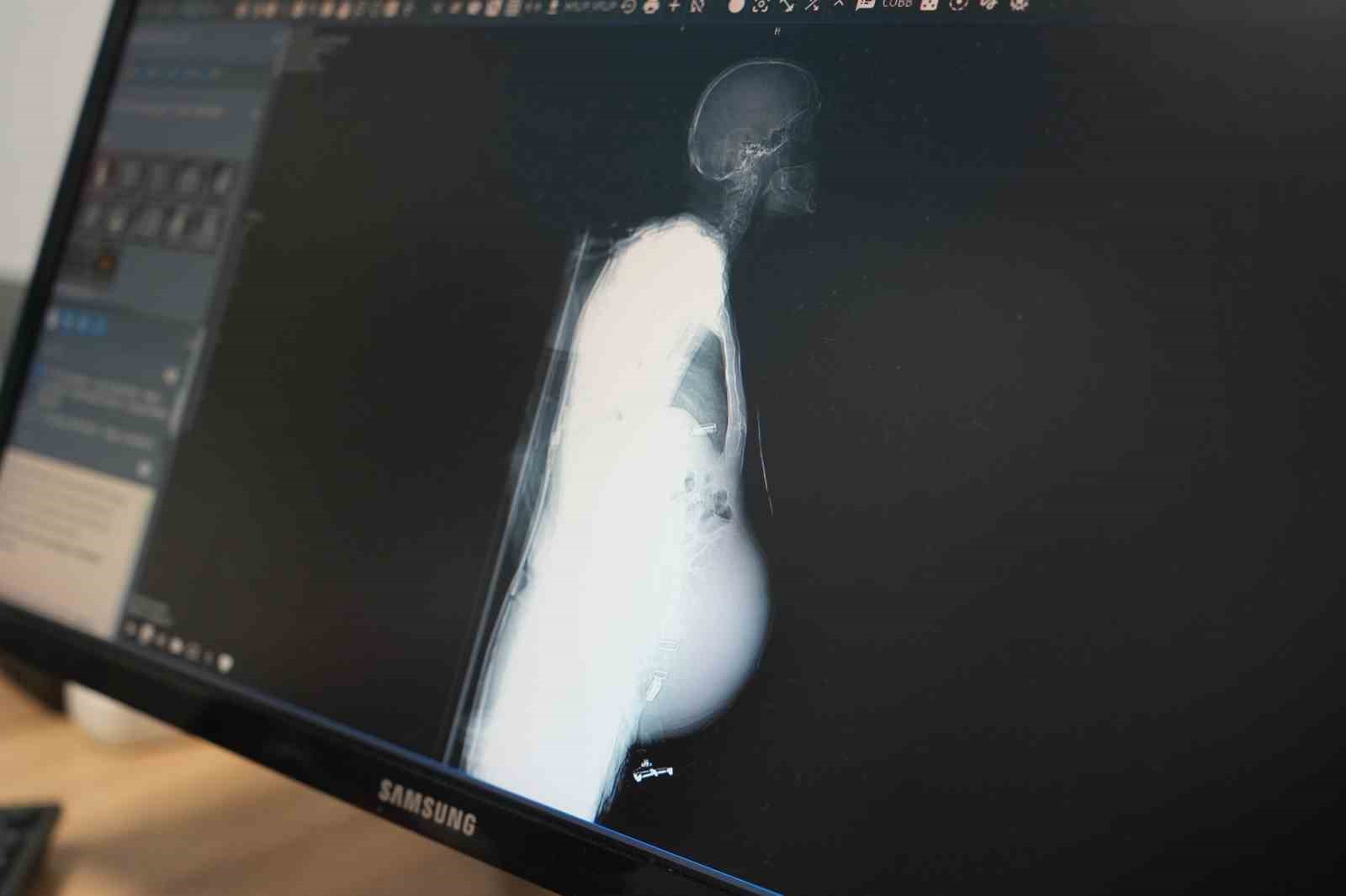 doktorlar gozlerine inanamadi 15 yil erteledigi ameliyatta karnindan dev kitle cikti 1 bj1Jy1np