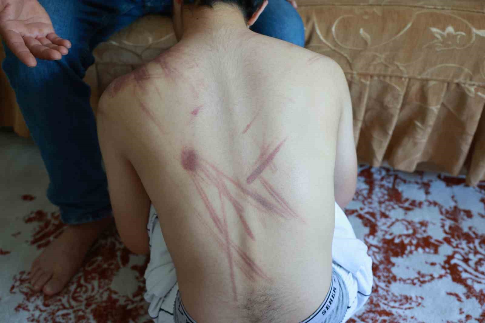 Down sendromlu oğlunun vücudundaki izleri görünce soluğu önce hastanede ardından adliyede aldı 4 down sendromlu oglunun vucudundaki izleri gorunce solugu once hastanede ardindan adliyede aldi 0 GskdfZz5