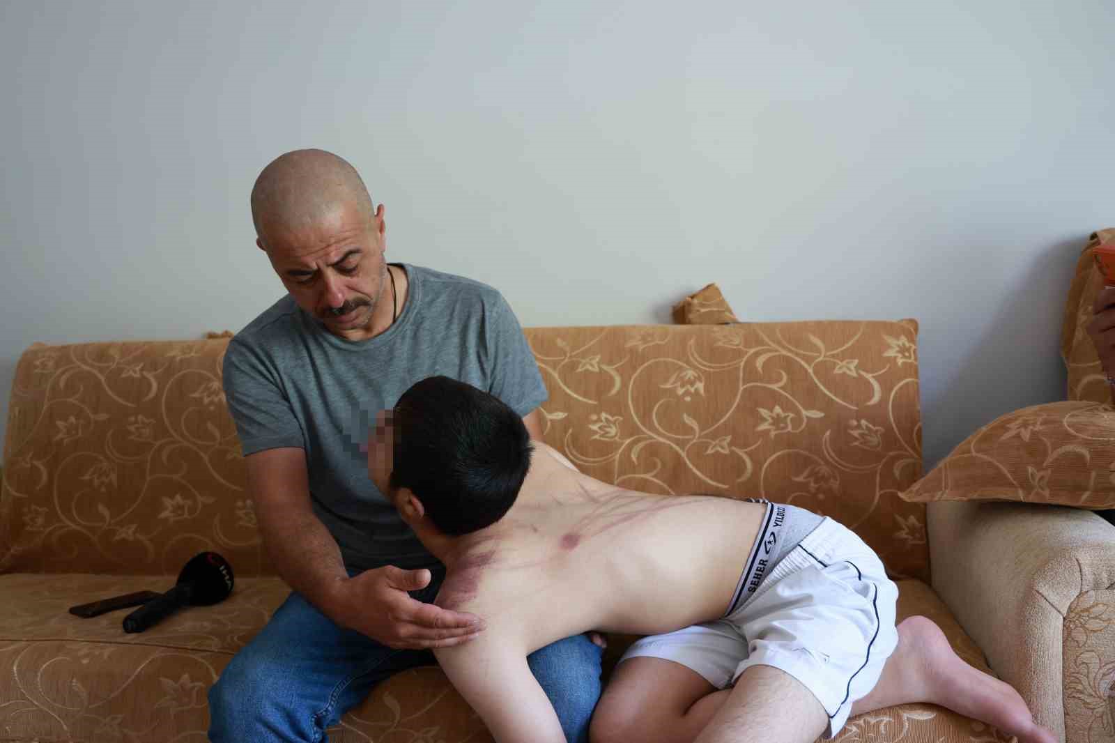 Down sendromlu oğlunun vücudundaki izleri görünce soluğu önce hastanede ardından adliyede aldı 5 down sendromlu oglunun vucudundaki izleri gorunce solugu once hastanede ardindan adliyede aldi 1 jL1iLXDP