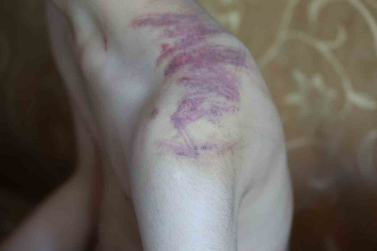Down sendromlu oğlunun vücudundaki izleri görünce soluğu önce hastanede ardından adliyede aldı 6 down sendromlu oglunun vucudundaki izleri gorunce solugu once hastanede ardindan adliyede aldi 2 35tlyDtR