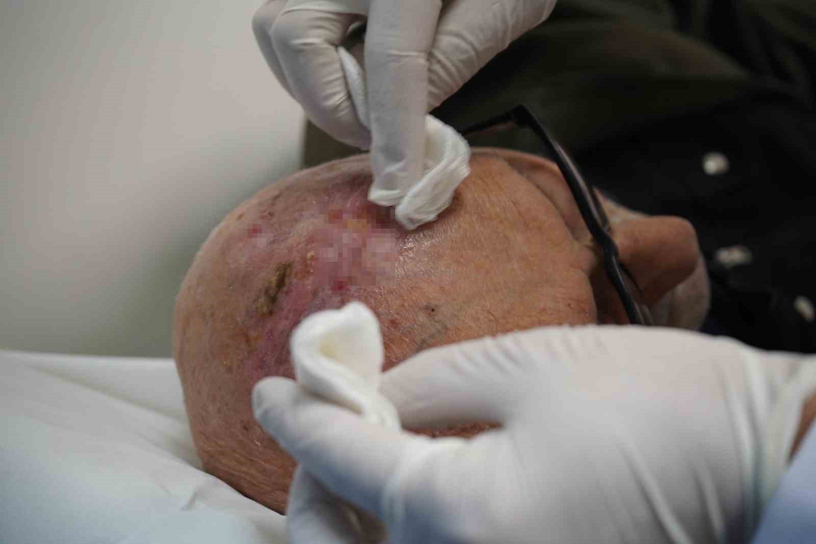 dunyada 3uncu kez rastlandi sacli derideki nadir tumor sakaryada tedavi edildi 1 4ejLA8FJ