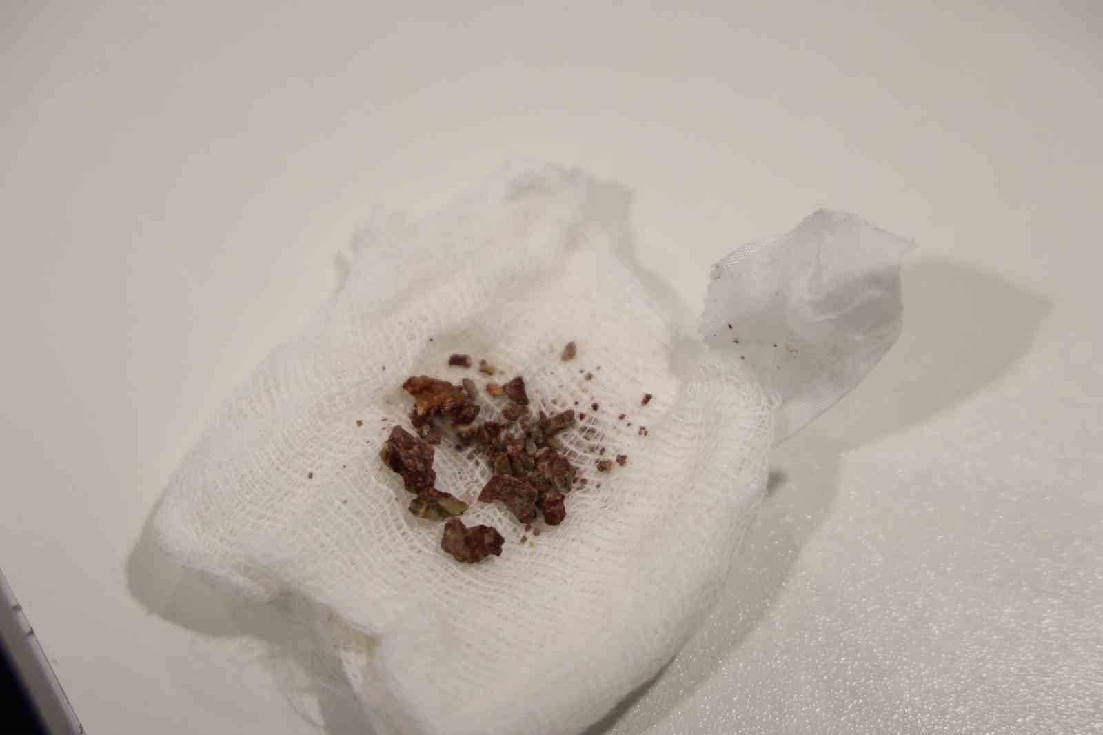 elazigda estetik ameliyatta sasirtan olay burundan tas cikti 3