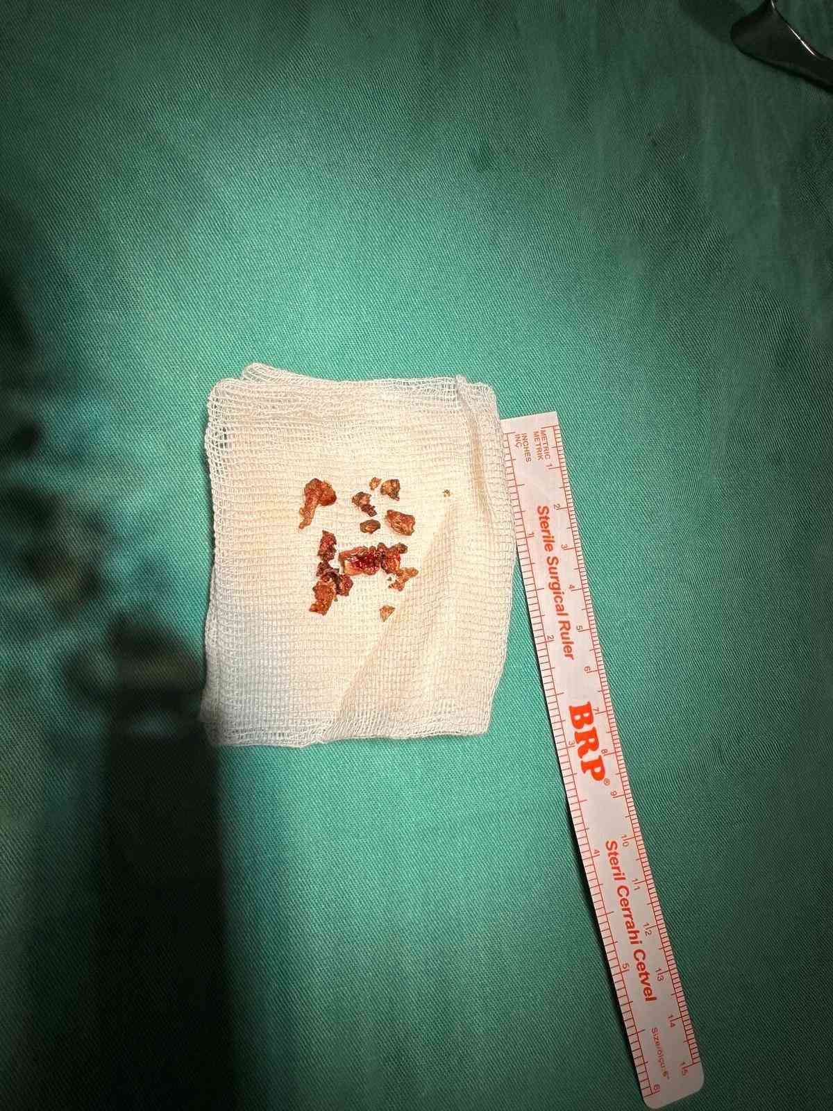 elazigda estetik ameliyatta sasirtan olay burundan tas cikti 4 W17Zeipz