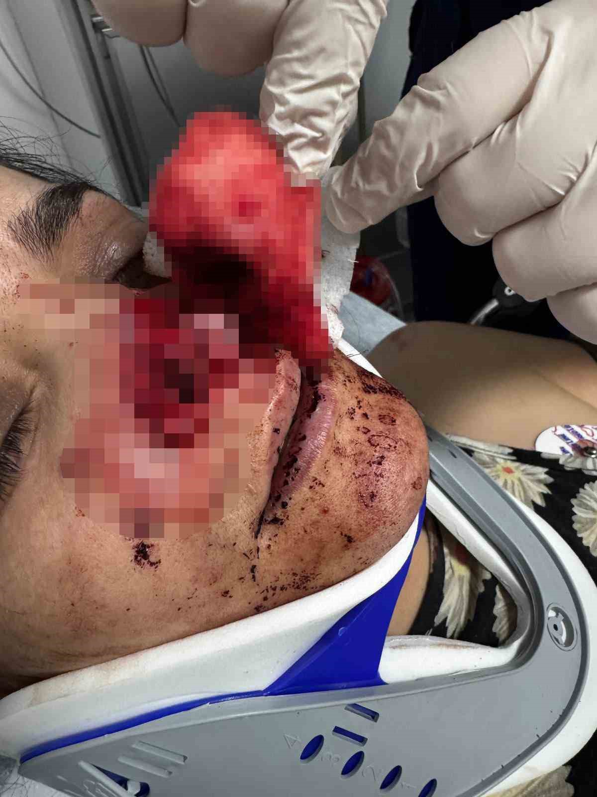 Eşinin kopardığı burnu başarılı operasyonla yerine dikildi 4 esinin kopardigi burnu basarili operasyonla yerine dikildi 0 iWemEgab