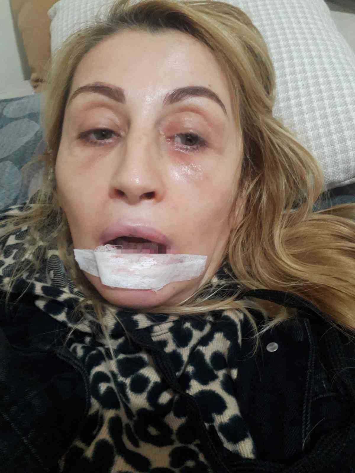 Estetik işlem sonrası dudağı çürüdü, 7 yıldır hukuk mücadelesi veriyor 6 estetik islem sonrasi dudagi curudu 7 yildir hukuk mucadelesi veriyor 2