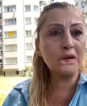 estetik-islem-sonrasi-dudagi-curudu-7-yildir-hukuk-mucadelesi-veriyor-f7zVx7nI.jpg
