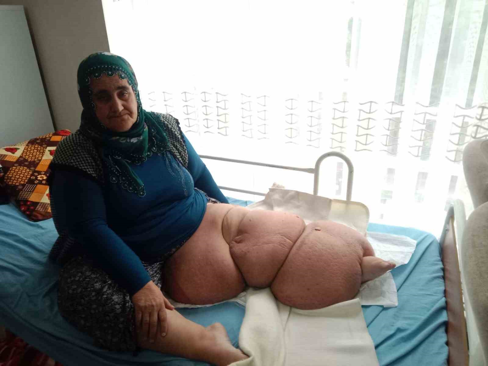 fil hastaligi bacagini 100 kilo yapti tedavisinin devami icin destek bekliyor 2 DmsHyMXU