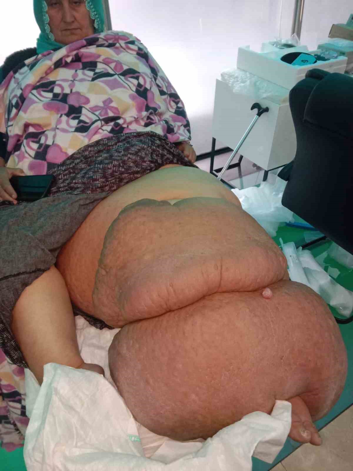fil hastaligi bacagini 100 kilo yapti tedavisinin devami icin destek bekliyor 3 sJddHzEI