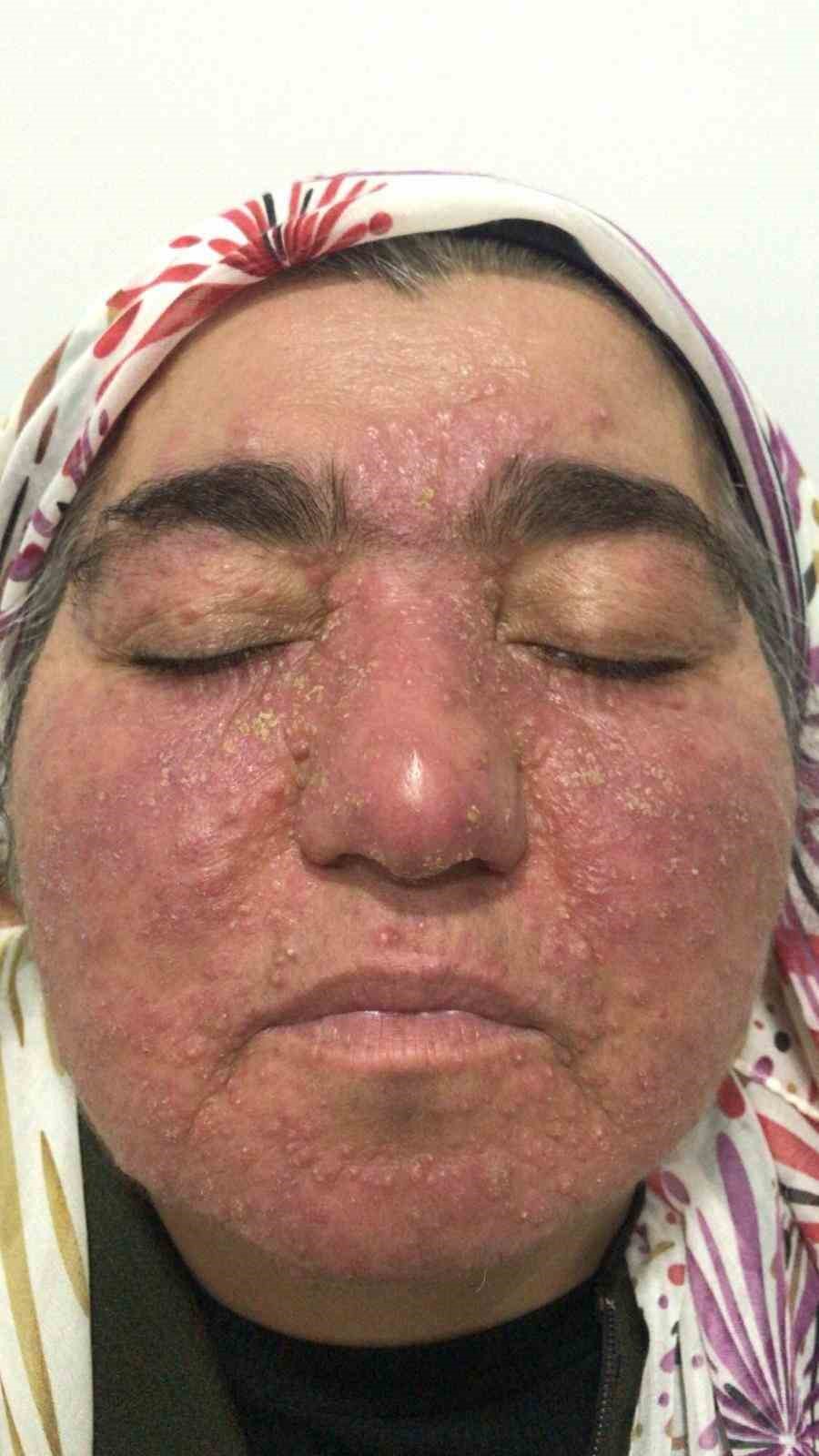 hastaligi yuzunden yillarca evden cikamadi simdi ise cekinmeden cikabiliyor 6 7wSNPT8t