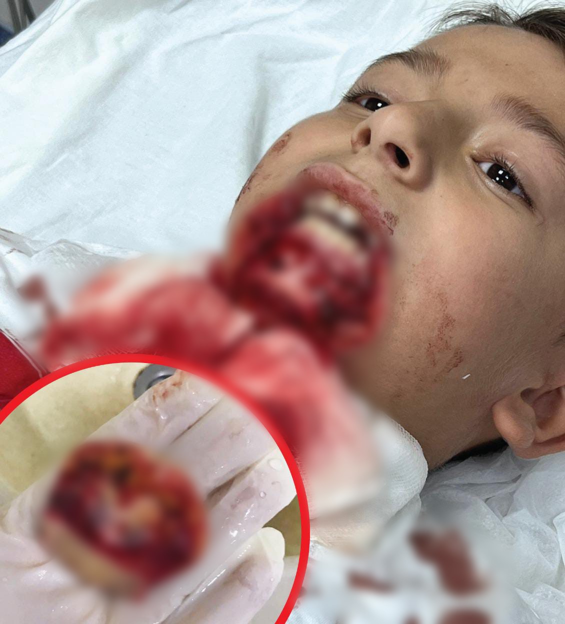 ilkokul ogrencisinin cenesi saplanan demir yuzunden koptu ailesi okula ihmal davasi acti 2 Fjf4NipW