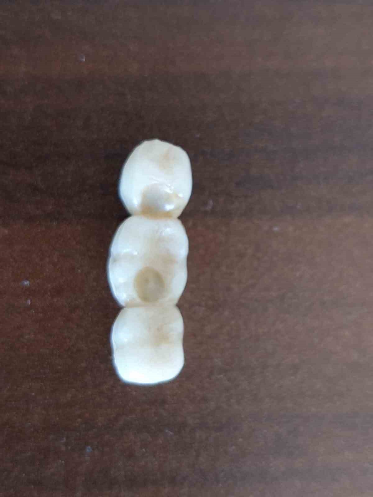 implant elinde hasta sikayette 5 SmkGic9E