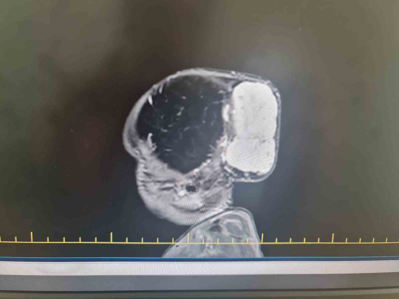 kafasindaki nadir tumor alindi hayata tekrar gulumsedi 1 d2HCFgds