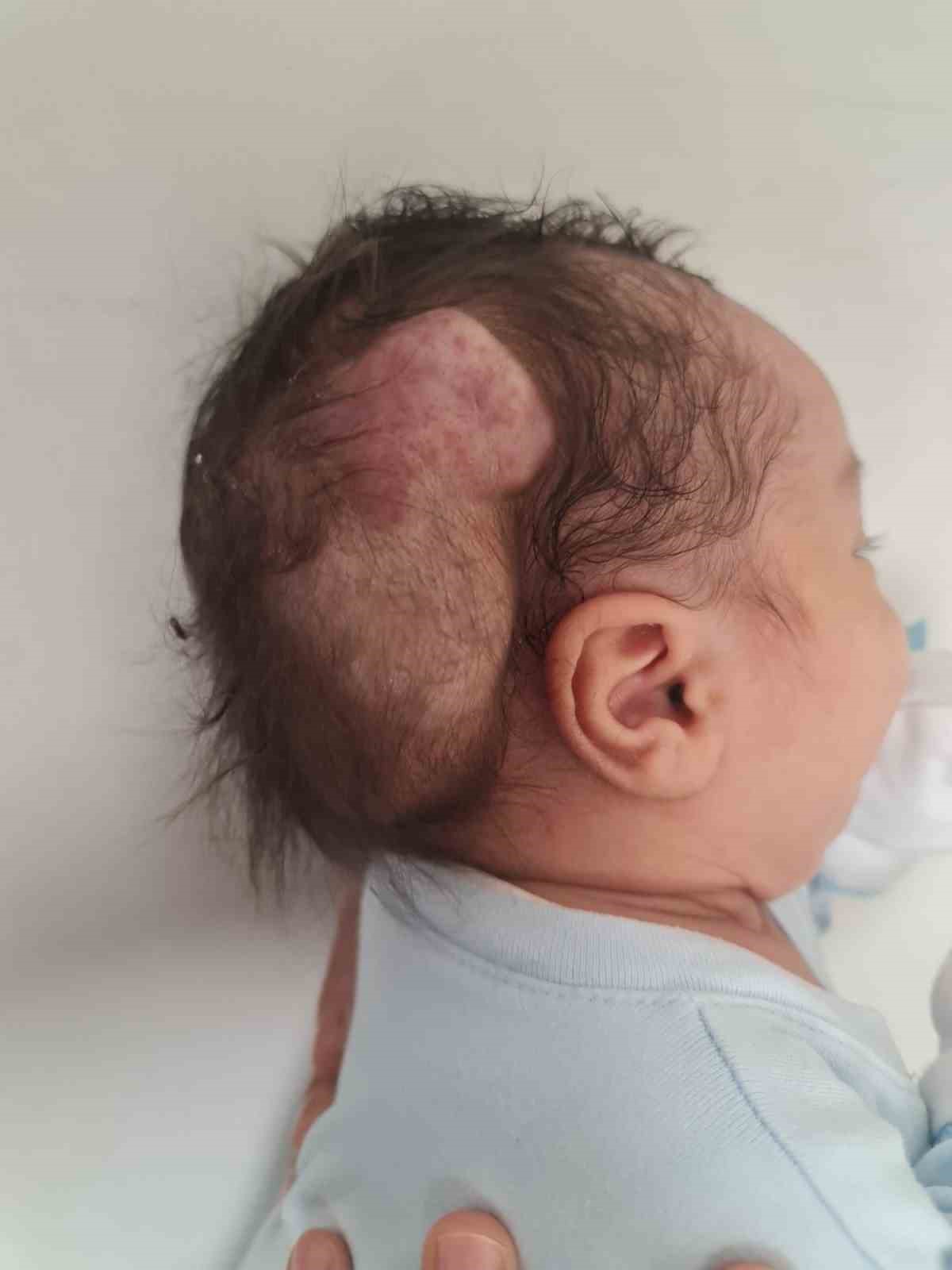 kafasindaki nadir tumor alindi hayata tekrar gulumsedi 8 I3FcBt51