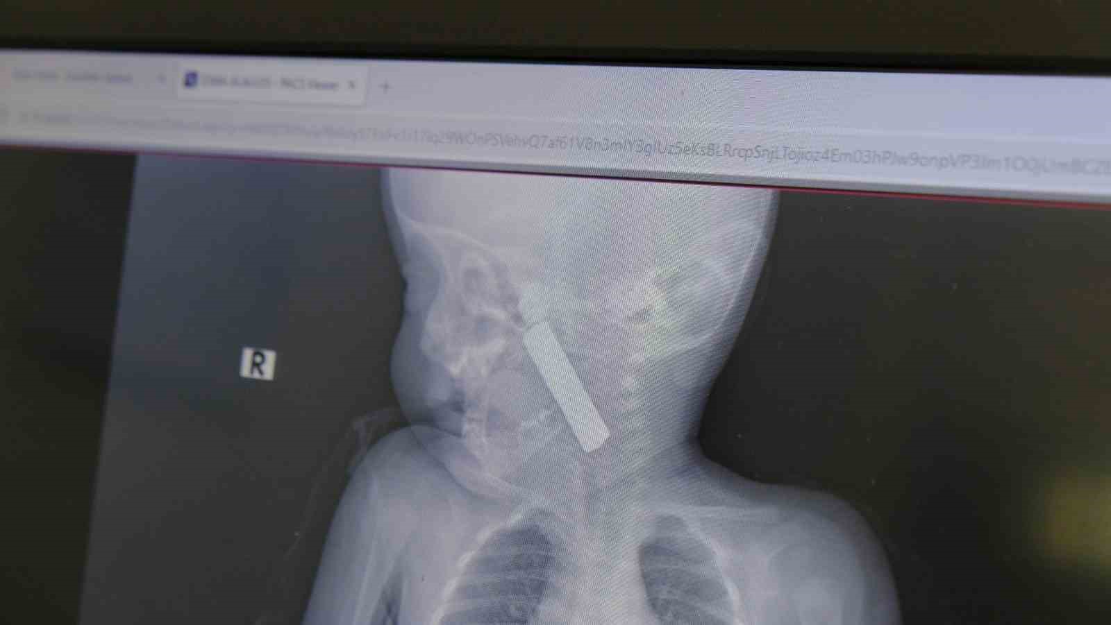 karamanda bogazina kumanda pili kacan bebek olumden dondu 1 J5qMsKlM