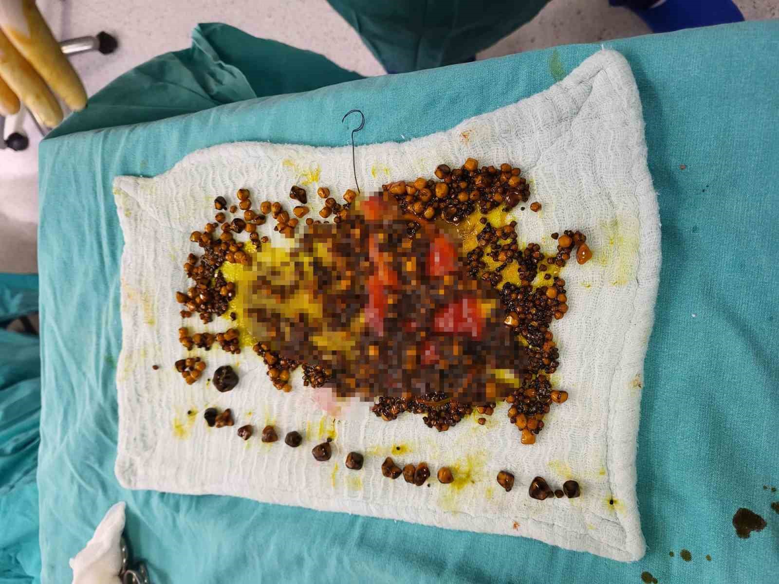 karin agrisiyla gitti safrasindan binlerce tas cikti 2 v9s3pfjH