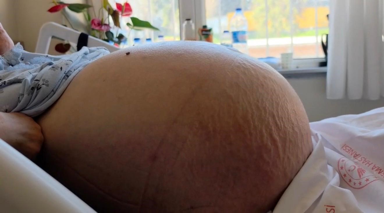 Karnındaki devasa şişlik 22 kiloluk tümör çıktı: "Kabızlık diye düşündüm" dedi 5 karnindaki devasa sislik 22 kiloluk tumor cikti kabizlik diye dusundum dedi 1