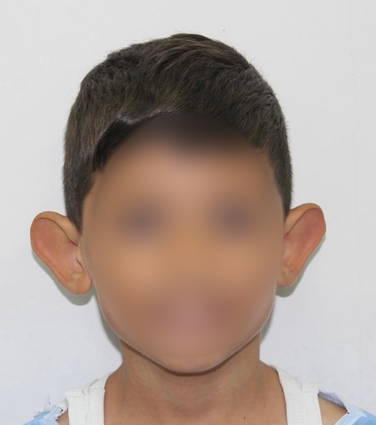kepce kulak sorunu cocuklarda ozguveni zedeliyor 1 1vTRIMAe