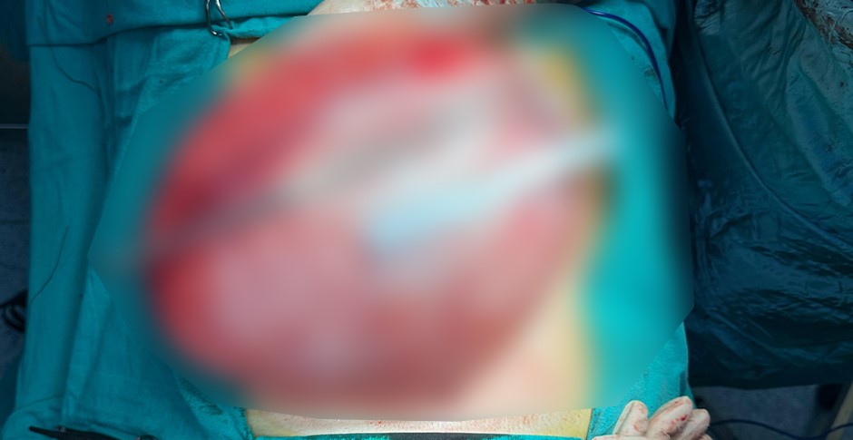 kilo vermek icin hastaneye giden cocugun karnindan 35 kiloluk kist cikti 0 hvYLiDZV