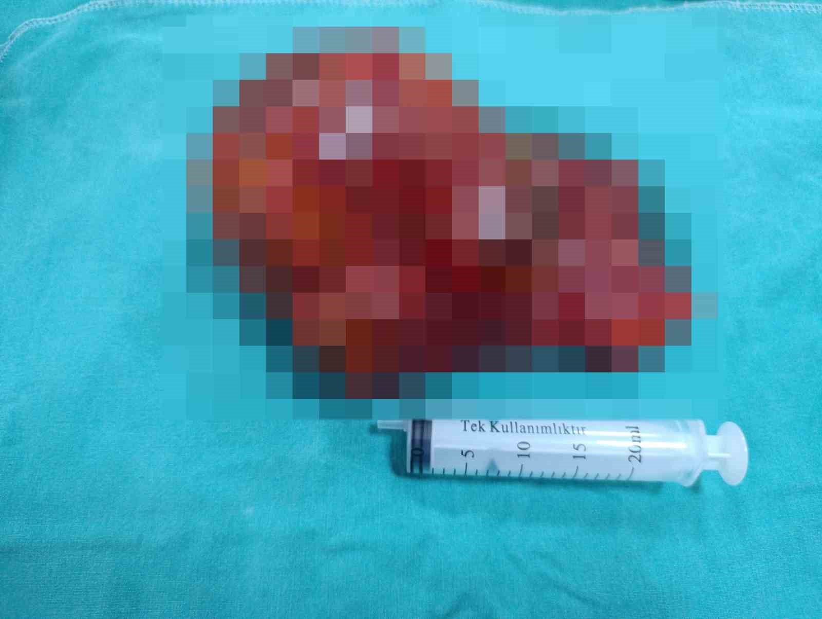 malatyada 20 santimetrelik kitle kapali yontemle cikarildi 2