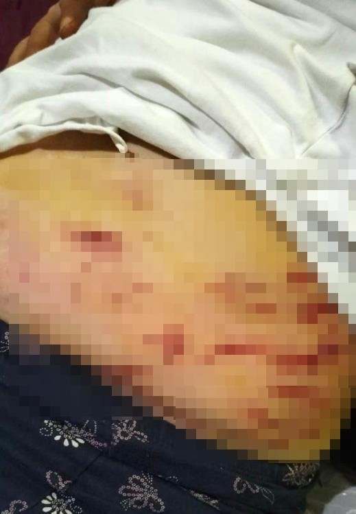 mersindeki kopek dehseti kopegin isirdigi anne yasananlari anlatti 4 wSlLzpnv