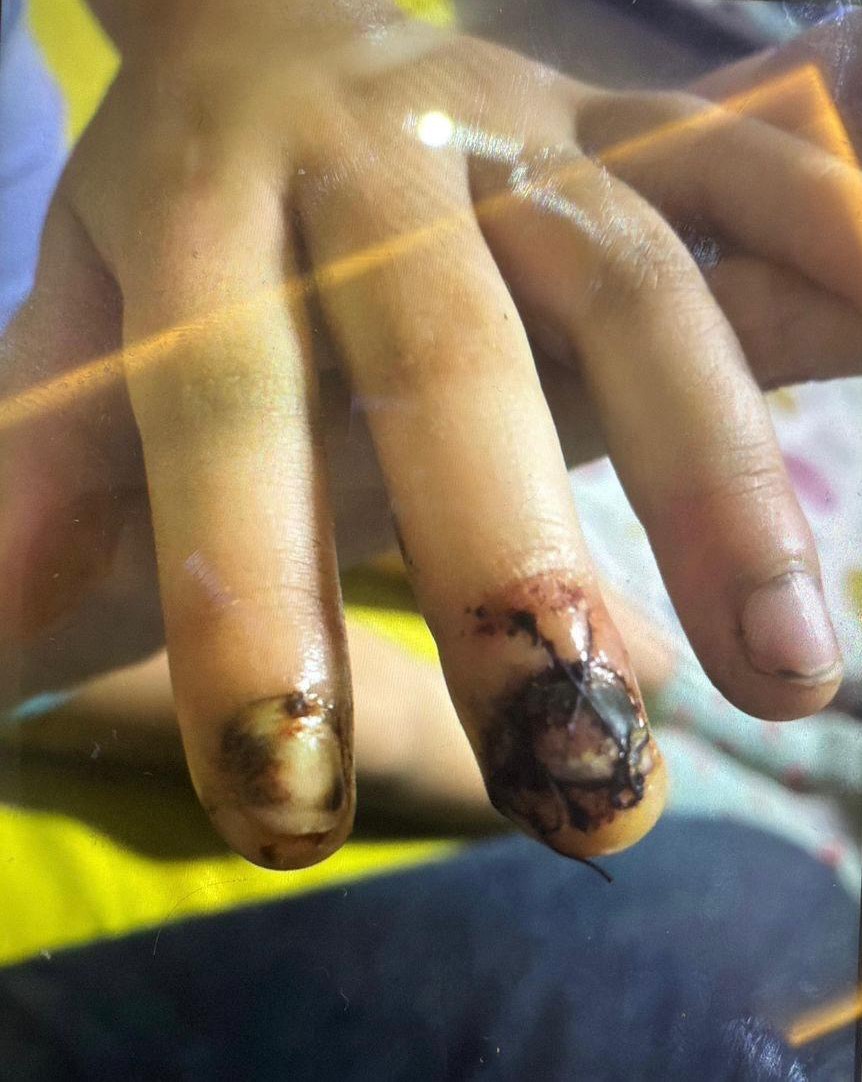 ozel okulda skandal goruntu kameraya yansidi cocugun parmaklari bu hale geldi 1 UQRktH5U