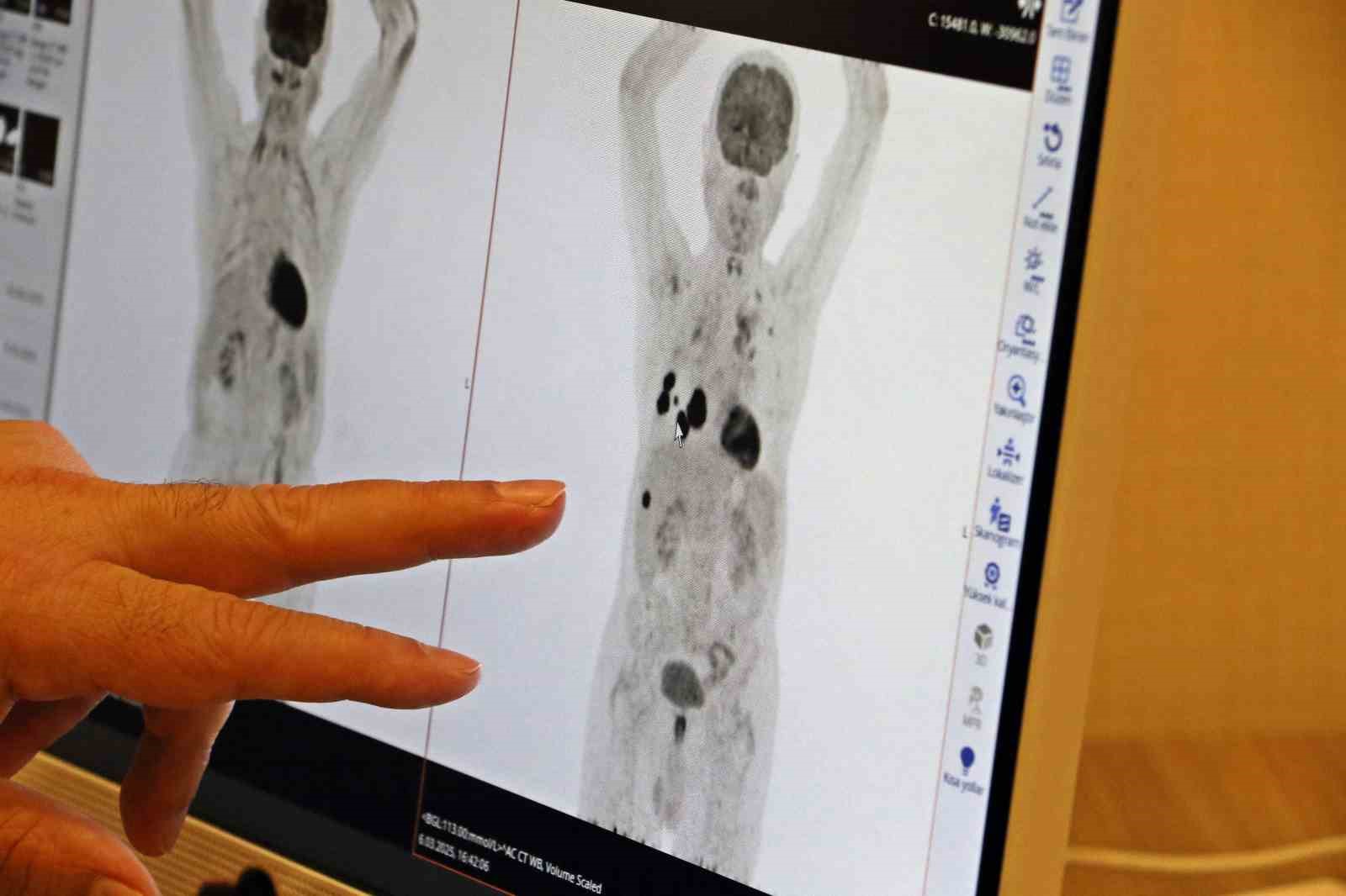 prof dr ali murat tatli akciger kanseri tedavisinde sag kalim oranlari artiyor 1 7BO2gpkC