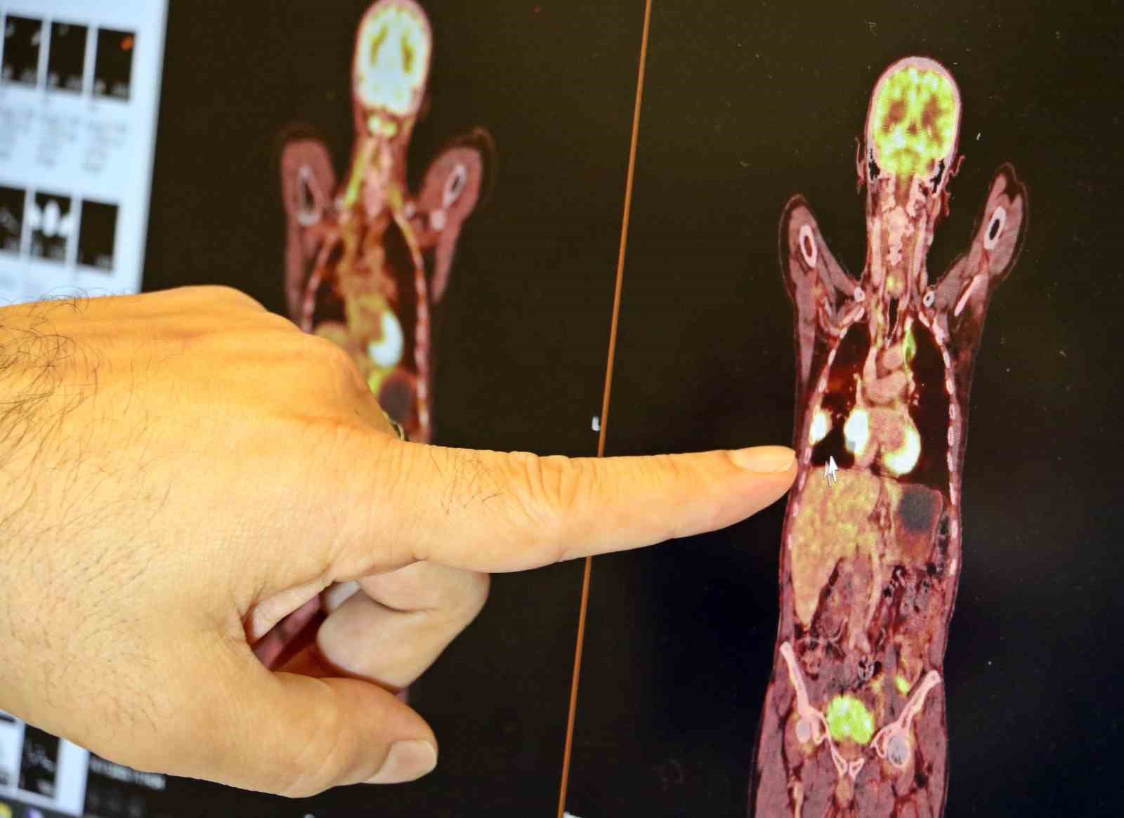 prof dr ali murat tatli akciger kanseri tedavisinde sag kalim oranlari artiyor 3