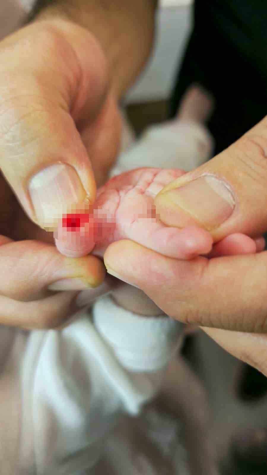 serum cikarma islemi esnasinda sargiyla birlikte bebegin parmagi kesildi 5 9KzO21WY