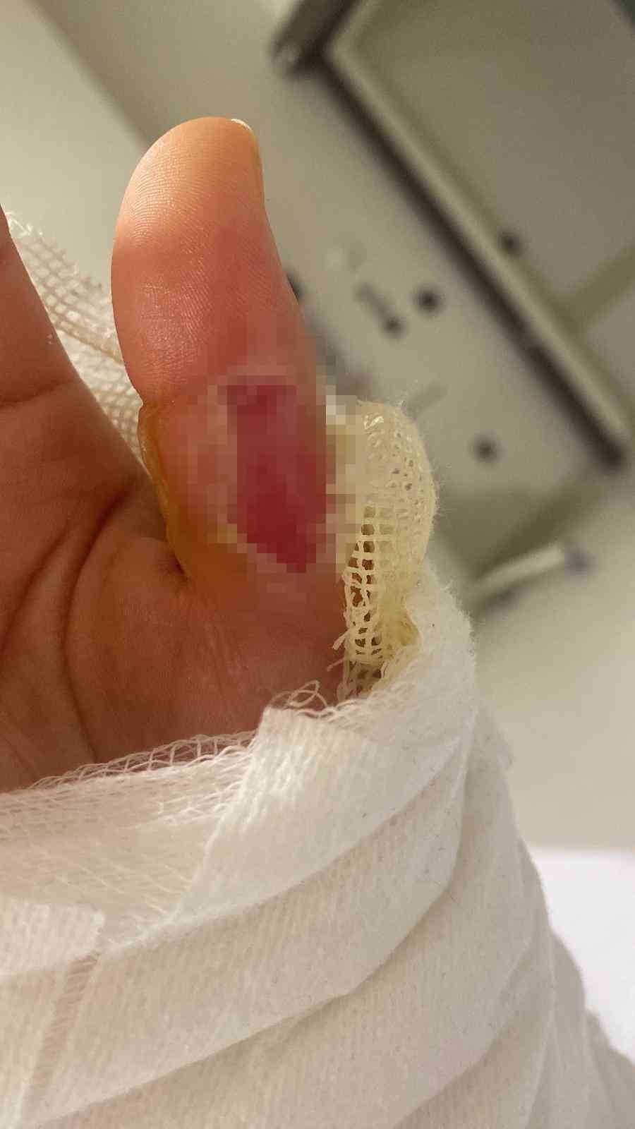 sicak su torbasi patladi genc kizin vucudunun yuzde 25i yandi o acinin tarifi yok CUmHO23Q