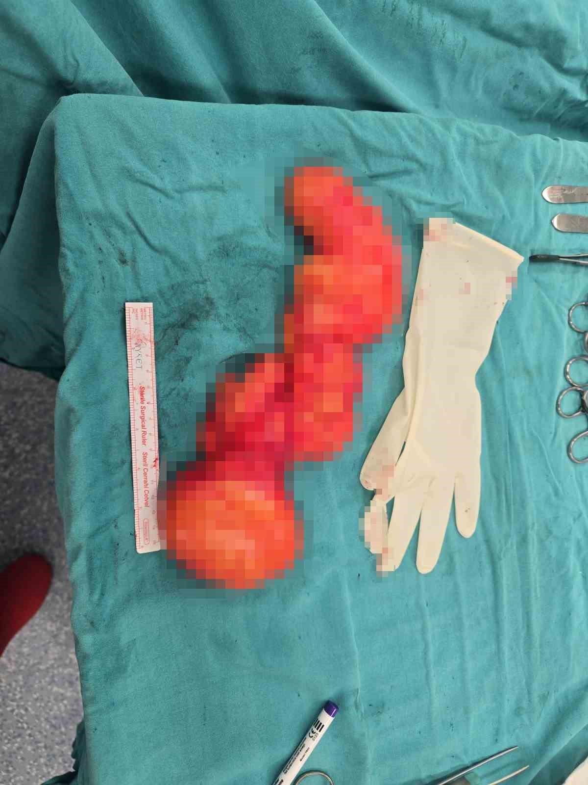 sirtindaki 10 yillik kitlenin icinden 1 bucuk kilogramlik tumor cikti 5 BElNsn5f