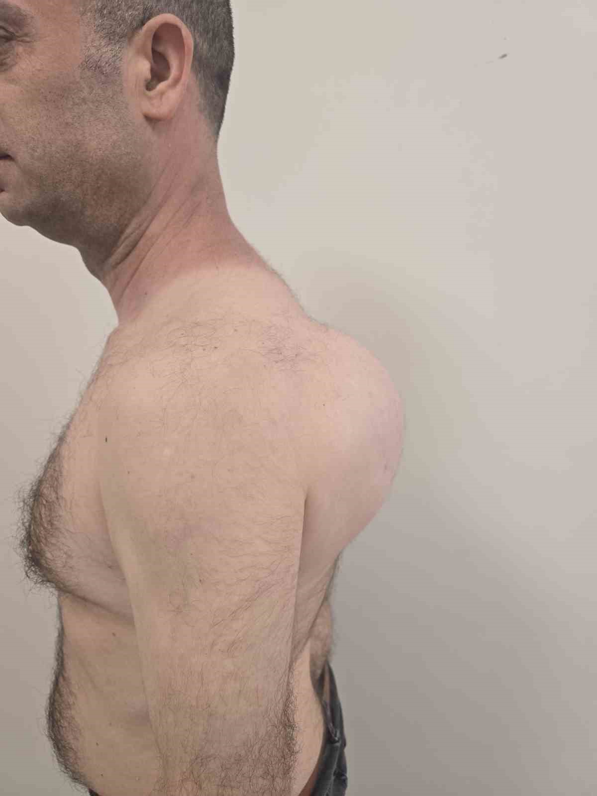 sirtindaki 10 yillik kitlenin icinden 1 bucuk kilogramlik tumor cikti 6 BYLsjB7b