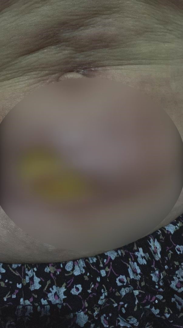 yag aldirma ameliyati gecirdi hayati karardi 2 6s3w5WbV