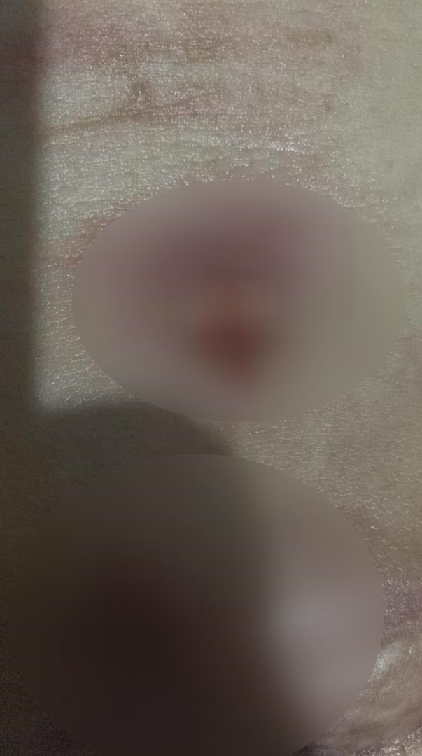 yag aldirma ameliyati gecirdi hayati karardi 3 mm5GZJty