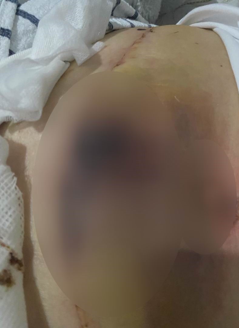 yag aldirma ameliyati gecirdi hayati karardi 4 a5fjzcZe